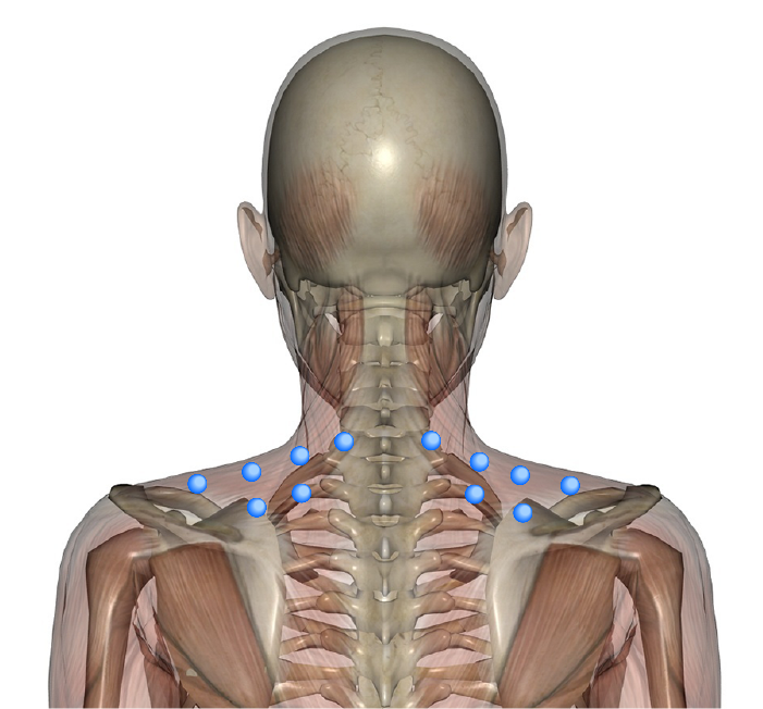 ボツリヌストキシン製剤(ボトックス)によるいかり肩や猪首の治療(肩から首筋の筋肉の縮小)