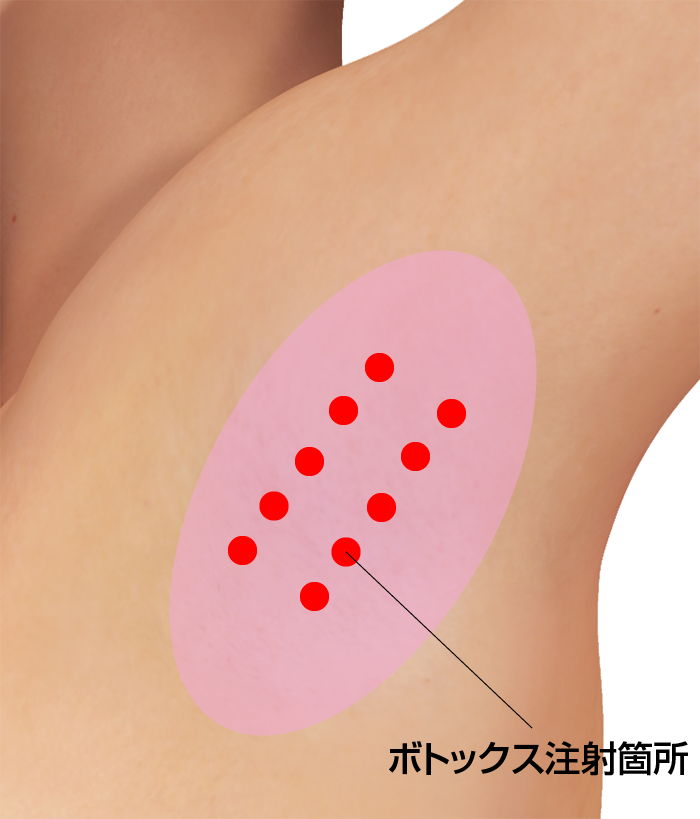 原発性腋窩多汗症でのボツリヌストキシン製剤(ボトックス)注入予定位置