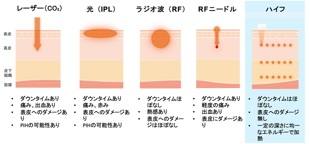 HIFU(ハイフ)と他の治療機器との違い