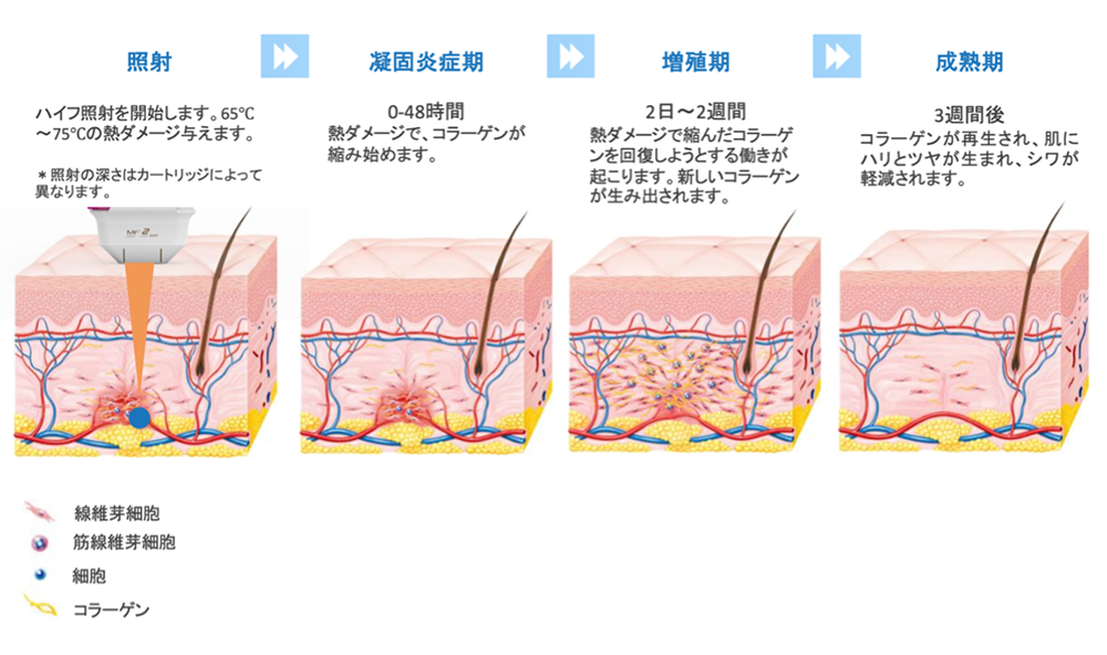 ハイフシャワー®、ハイフアイシャワー®による創傷治癒