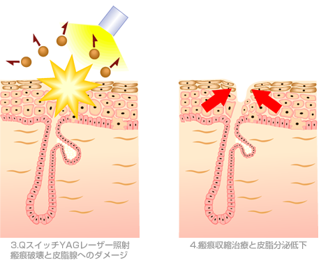 カーボンピーリング(レーザーピーリング)のイメージ2