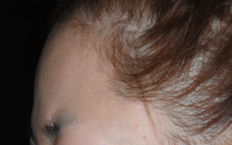額の骨(前頭骨)をきれいにする手術の術前 症例 上部側面