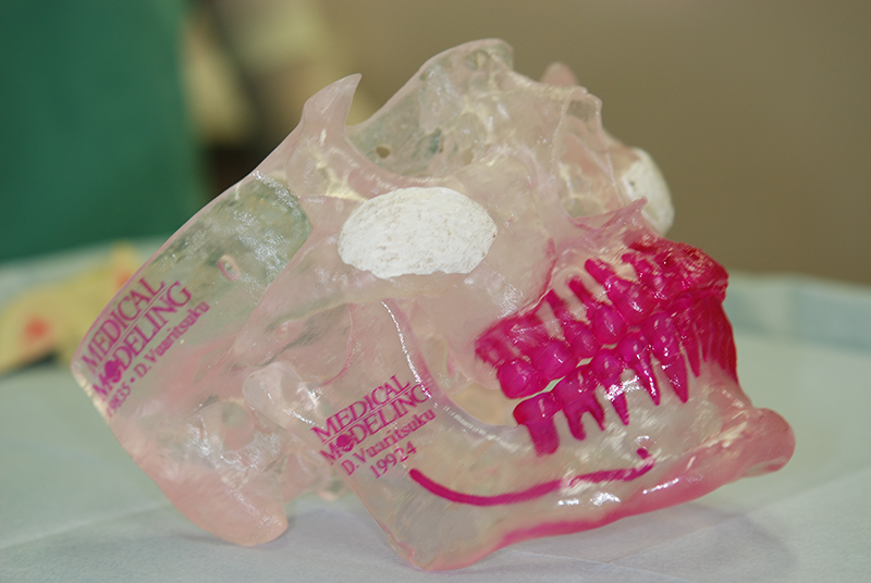 3Dプリント模型を使用してインプラントする人工骨(バイオペックス)のカスタマイズを行う