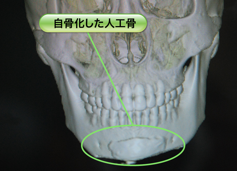 ペースト状ハイドロキシアパタイト製剤(人工骨)を使った頤形成の術前症例