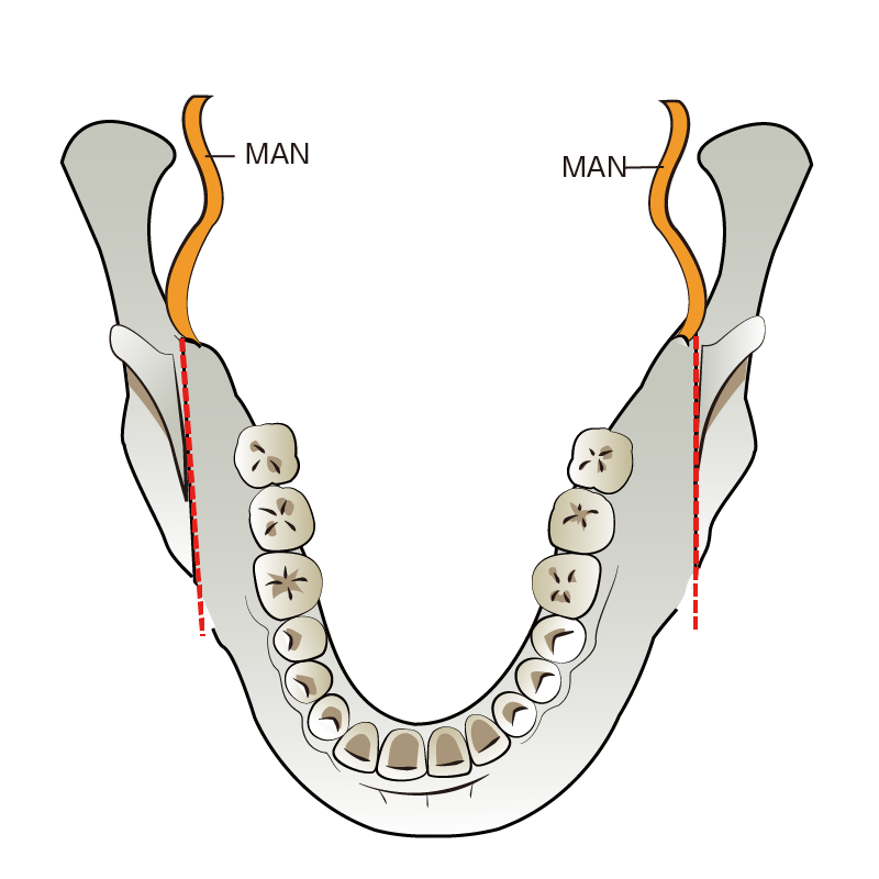 SSRO | 分離した歯槽骨を含む下顎骨片を前方に移動