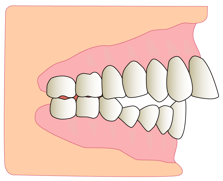 出っ歯の模式図