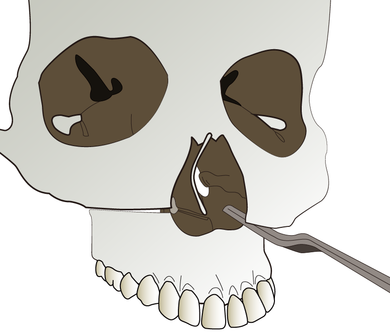 ルフォー1型骨切り術 | 上顎と上歯槽骨の間の骨切りを行う2