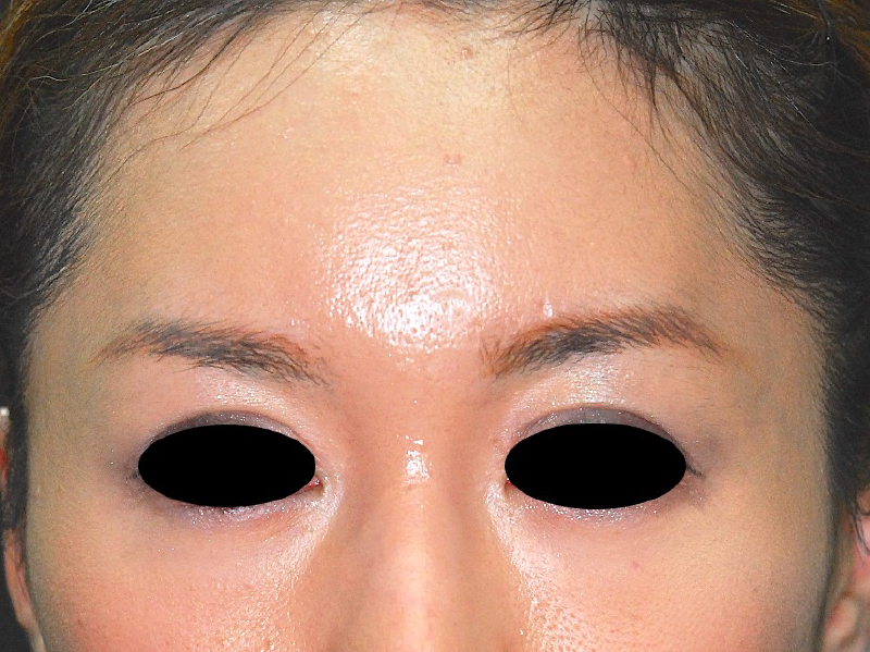 前額の骨(前頭骨(おでこ))を綺麗にする手術の症例 術前