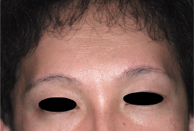 前額の骨(前頭骨(おでこ))を綺麗にする手術の症例 術前
