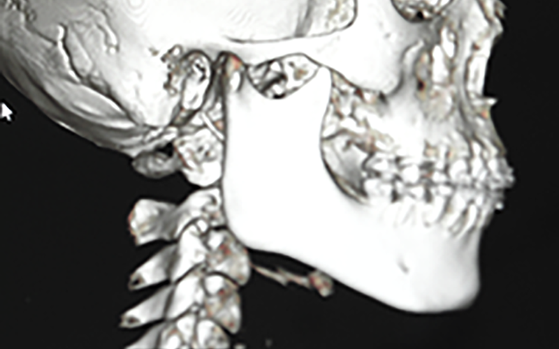 ペースト状ハイドロキシアパタイト製剤(人工骨)を使った頤形成手術 術前の3DCTの撮影