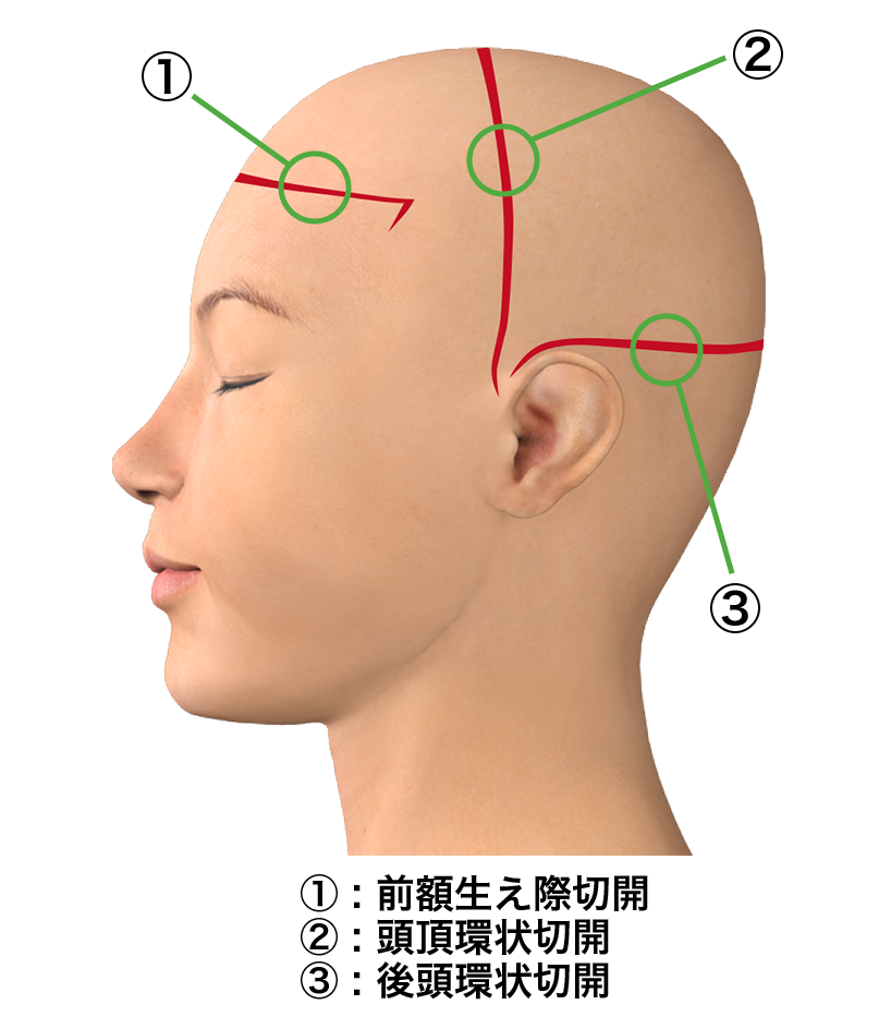 額の骨(前頭骨)をきれいにする手術での切開予定線 前額生え際切開 頭頂環状切開 後頭環状切開