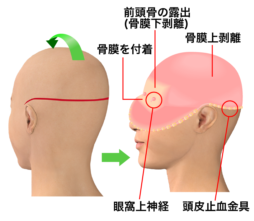 額の骨(前頭骨)をきれいにする手術の手術イメージ