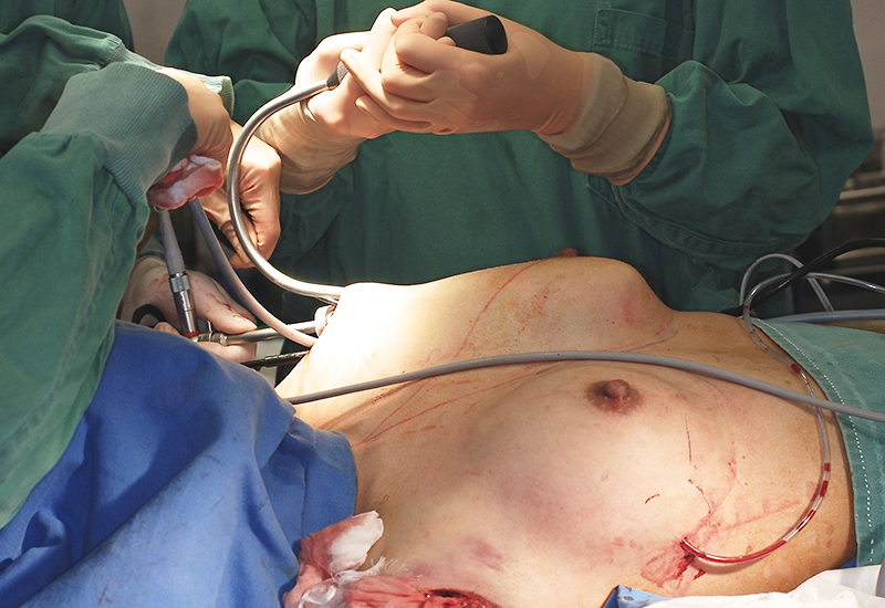 専用内視鏡を使用して豊胸術手術