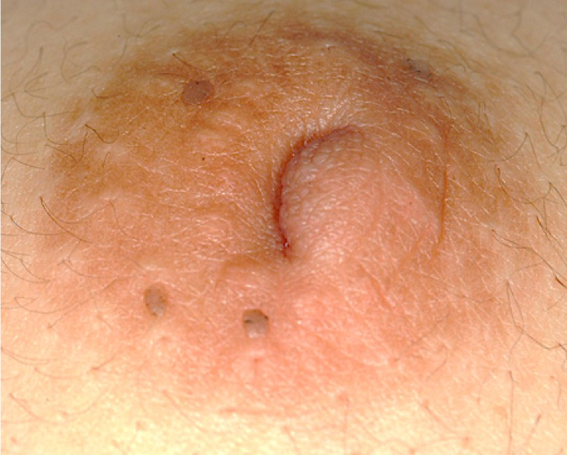 陥没乳頭術 術前