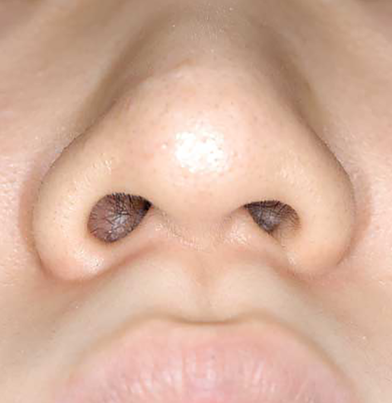 鼻尖軟骨形成手術の術前症例