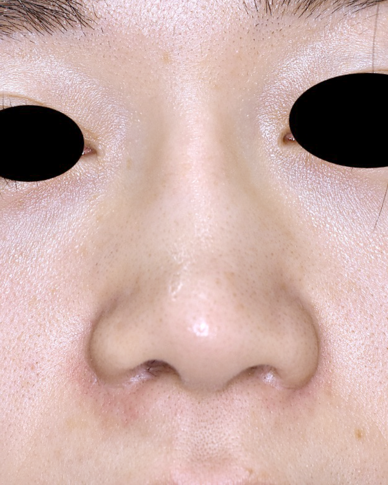 人工骨を使用した劉備術の症例 術後