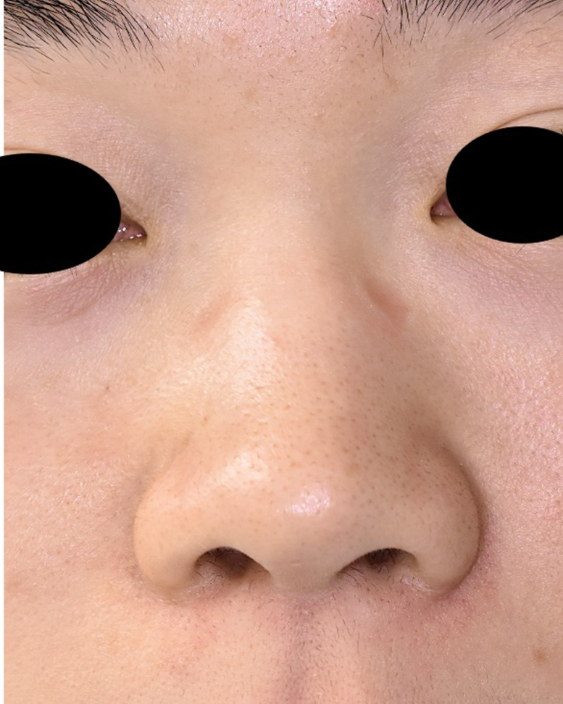 人工骨を使用した劉備術の症例 術前