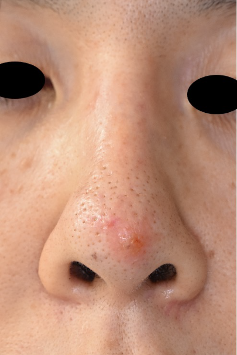 術前 鼻尖部の発赤を伴う感染兆候