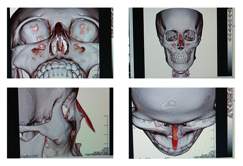CTスキャンでの顔面骨の立体画像