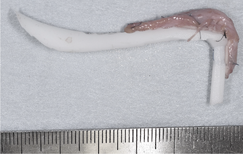 プロテーゼと耳介軟骨による隆鼻術の症例 術後