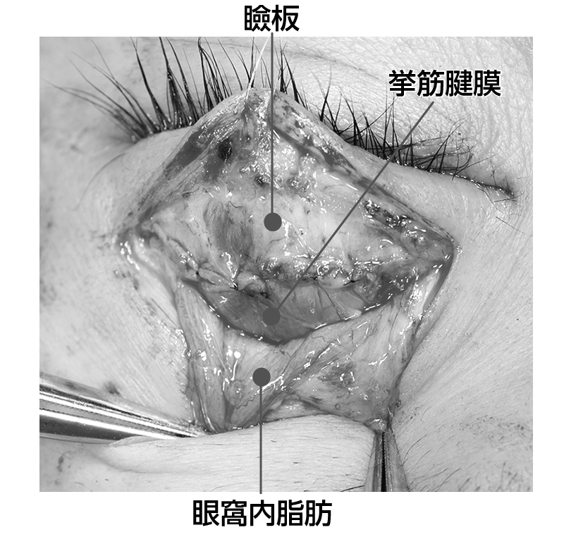 眼瞼下垂手術で挙筋腱膜を引き下げたところ 眼瞼 挙筋腱膜 眼窩内脂肪