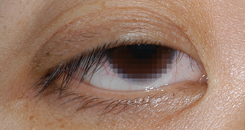眼瞼下垂症の例