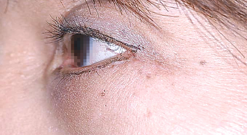 目袋の膨らみ(ティアトロフ)の矯正 術後1年目 症例 左目