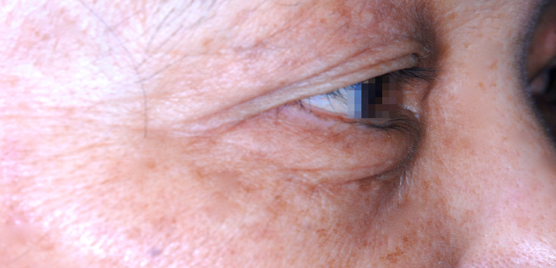 下眼瞼(下まぶた)のしわ・弛み・ふくらみ取り 術前 症例 右目