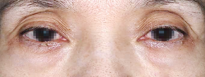 目袋の膨らみ(ティアトロフ)の矯正 術前 症例