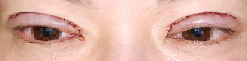 左側が奥二重の重瞼 切開式二重まぶた 術直後 開眼 症例