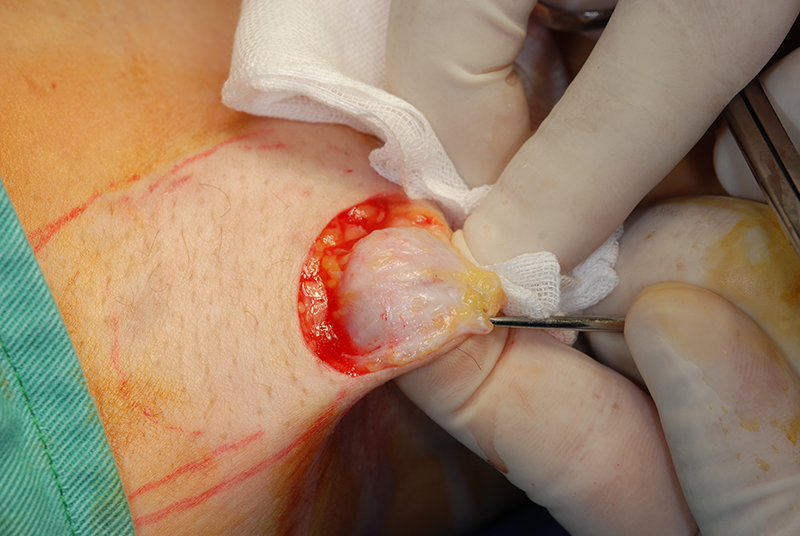 剪除法によるわきが手術 皮下組織の切除
