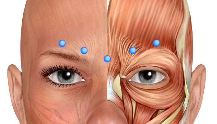 ボトックス(ボツリヌストキシン治療)の眉間のしわへの注入位置例