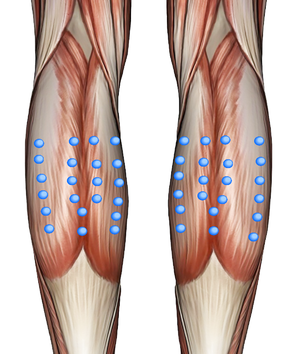 ボツリヌストキシン製剤(ボトックス)による大根足の治療(ひざ下の後ろの筋肉の縮小)
