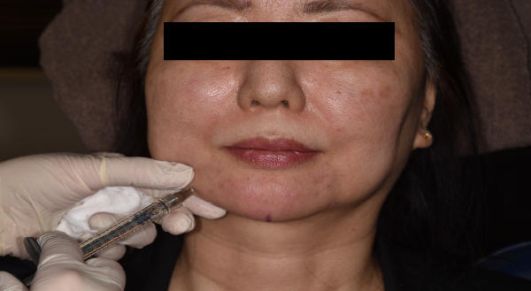 ヒアルロン酸フィラー等による皮下組織の充填 : 酒井形成外科 美容皮膚科