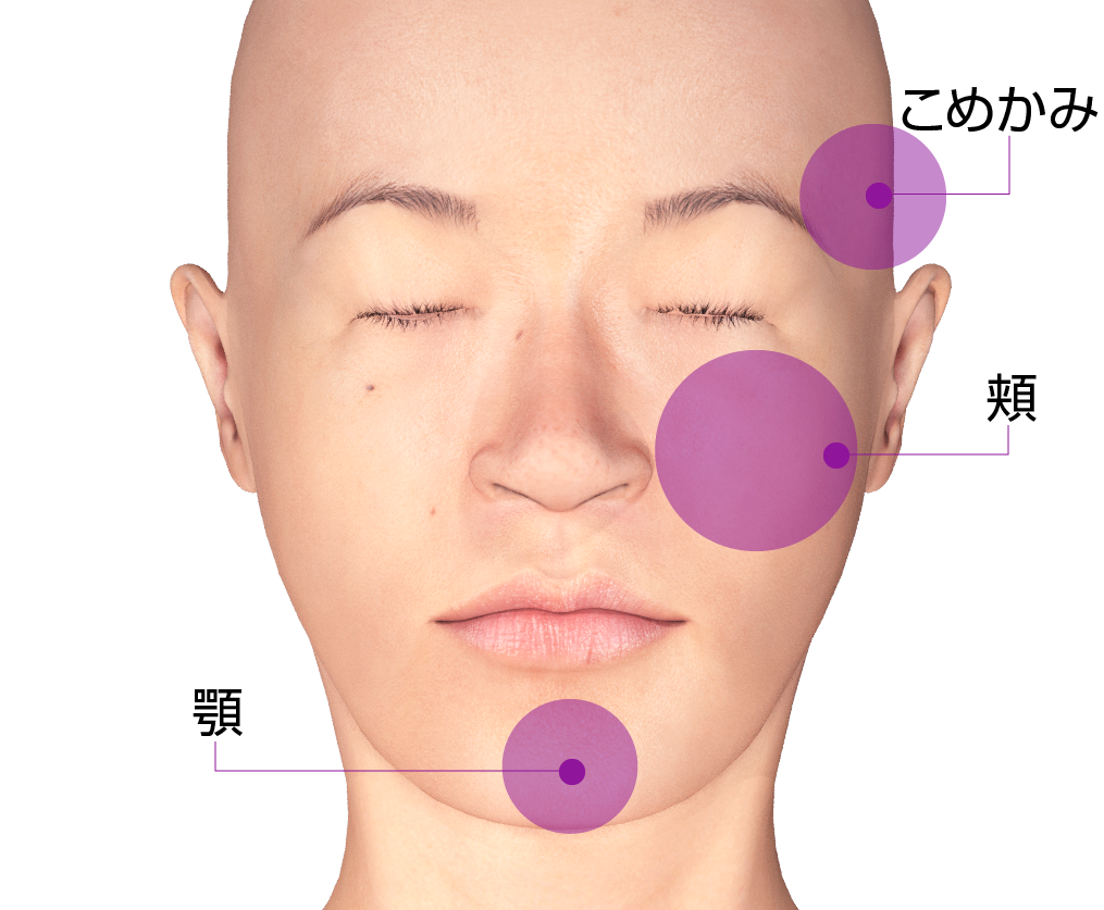 エイジングケアのためのヒアルロン酸フィラーの主な注入部位