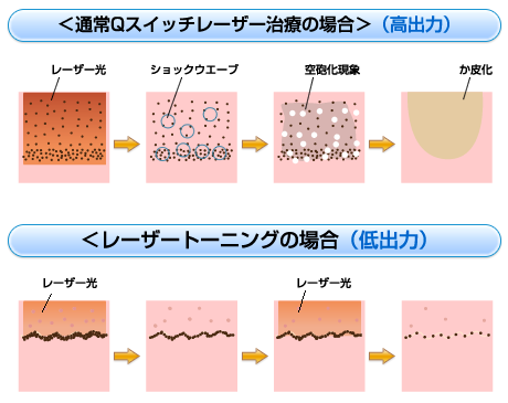 治療が難しかった肝斑に画期的効果をもたらす新レーザー