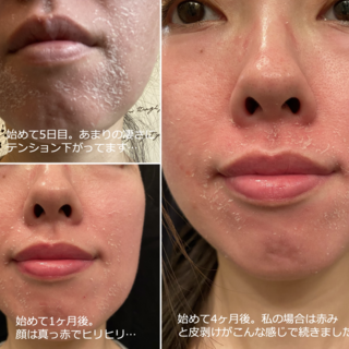 Zo Skin Health セラピューティックの気になるbefore After写真をご紹介 酒井形成外科看護師ブログ Zo Skin Health セラピューティックの気になるbefore After写真をご紹介 酒井形成外科看護師ブログ