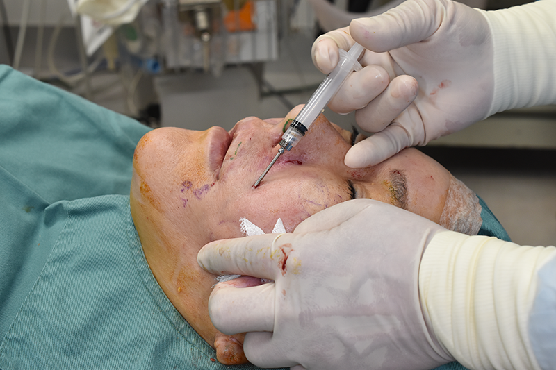 注射器で顔の陥凹部に脂肪を少しずつ注入していきます