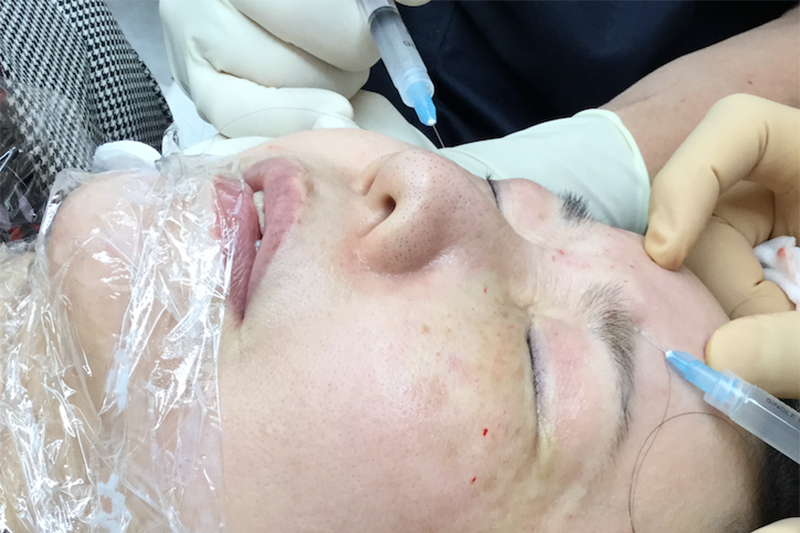 線維芽細胞の顔面皮膚への注入の実際 | 線維芽細胞浮遊液を真皮層に直接注入