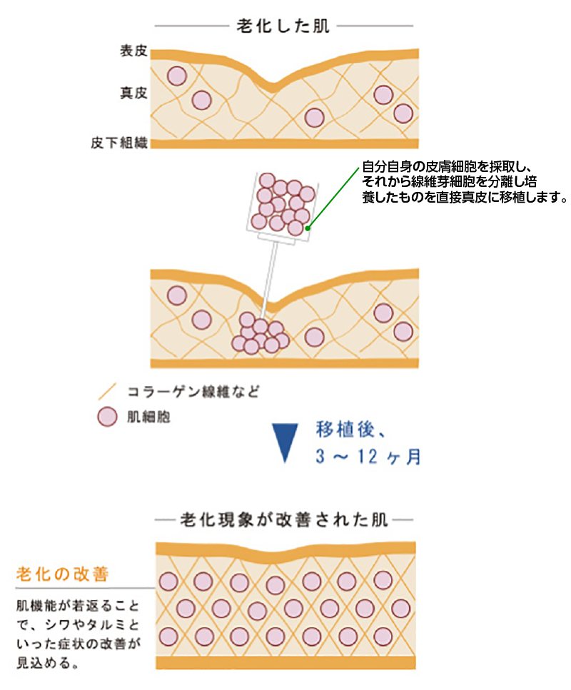 真皮繊維芽細胞両方の模式図