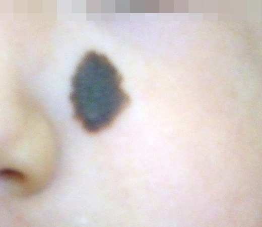 皮膚腫瘍の例(頬部):術前