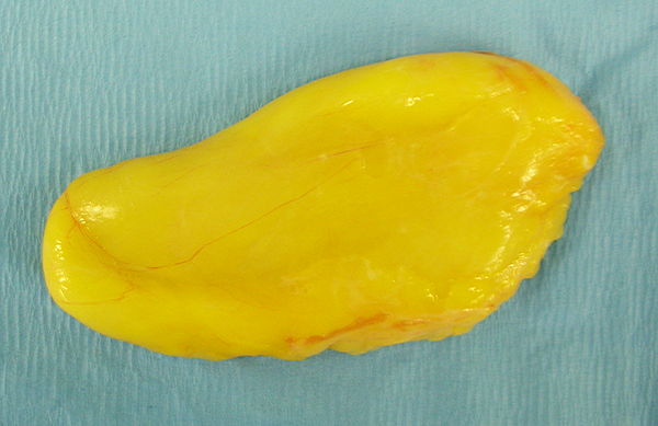 脂肪腫の切除手術:取り出した腫瘍