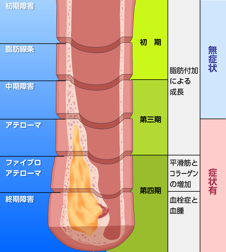 アテローマの進行