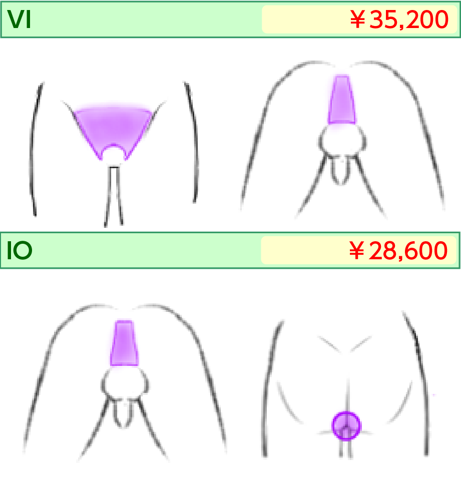 男性レーザー脱毛 VI・IO