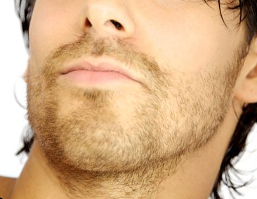 男性のひげは毛根直径が太く、剛毛になります。その場合でもスーパーパルスYAGレーザーで脱毛できます。