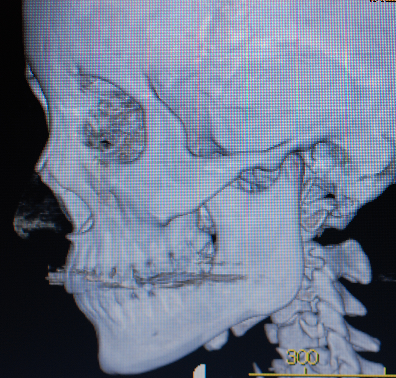 外側に跳ね上がっているえら骨の切除症例 3DCT画像