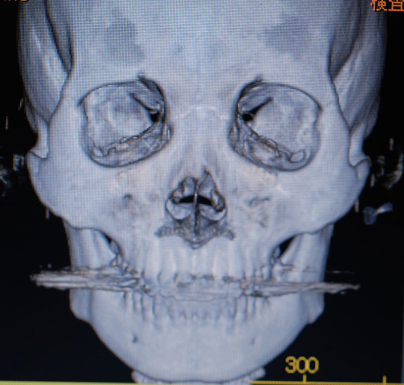 外側に跳ね上がっているえら骨の切除症例 3DCT画像