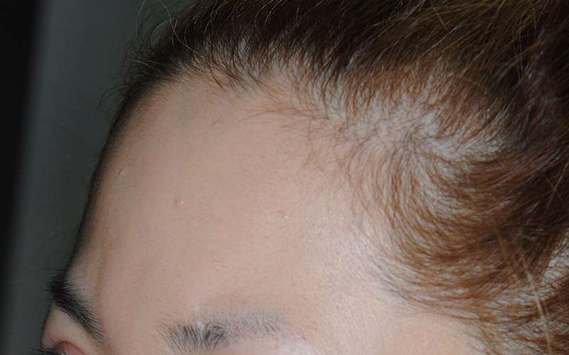 額の骨(前頭骨)をきれいにする手術の術前 症例 上部斜め前