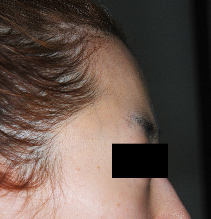 額の骨(前頭骨)をきれいにする手術の術前 症例 側面