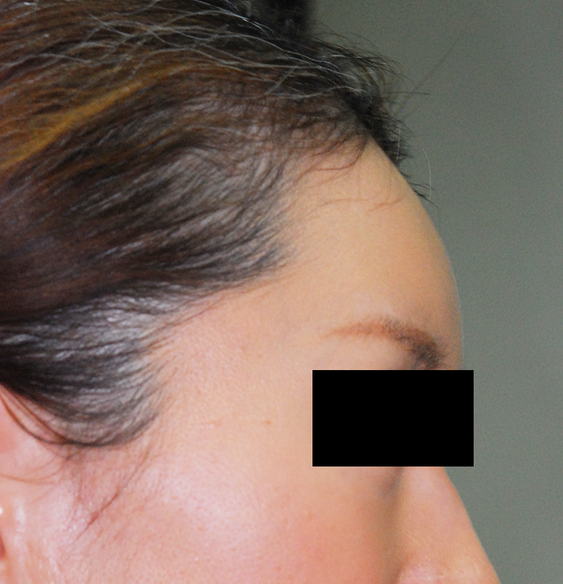 額の骨(前頭骨)をきれいにする手術の術後 症例 側面
